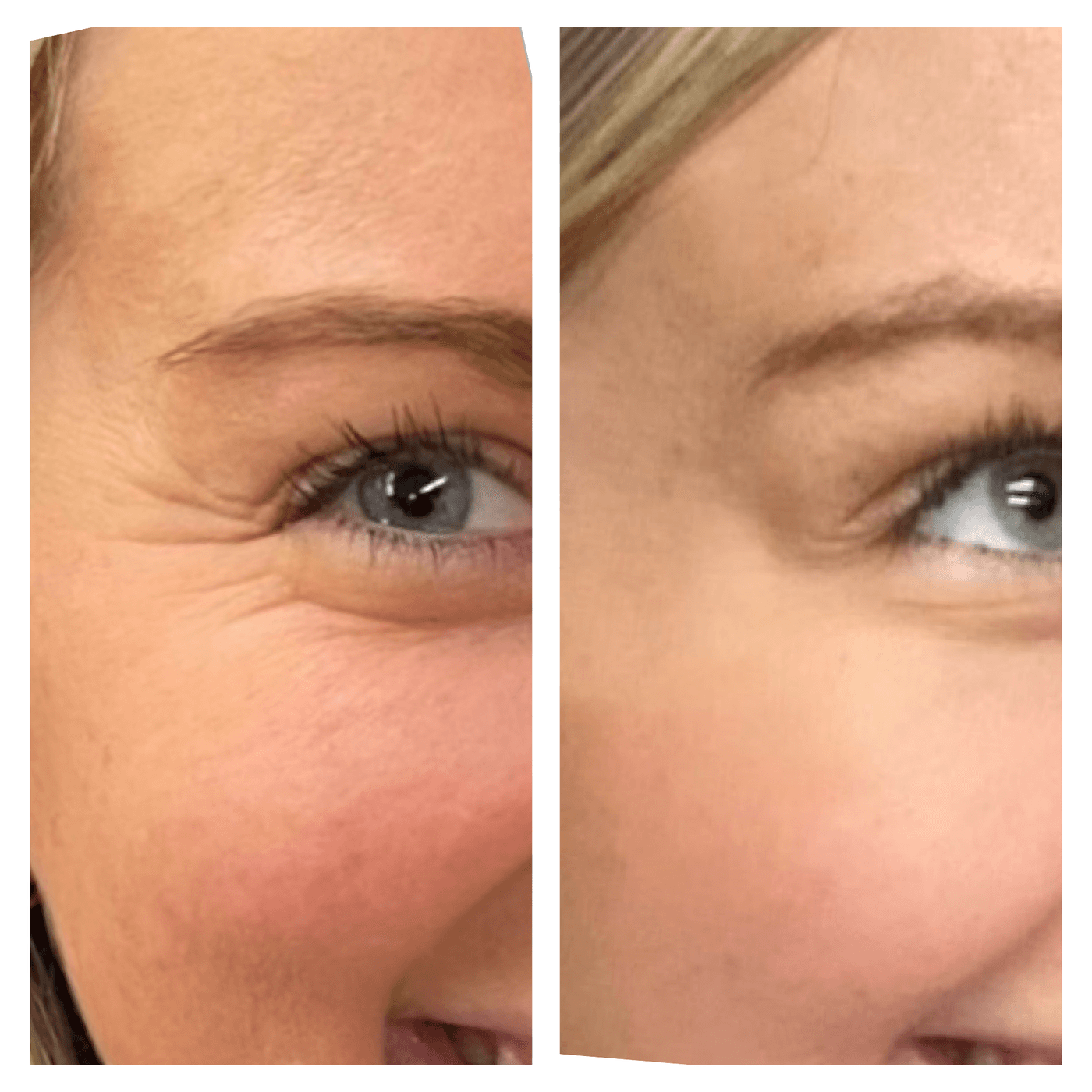 (bo)Tox before and after