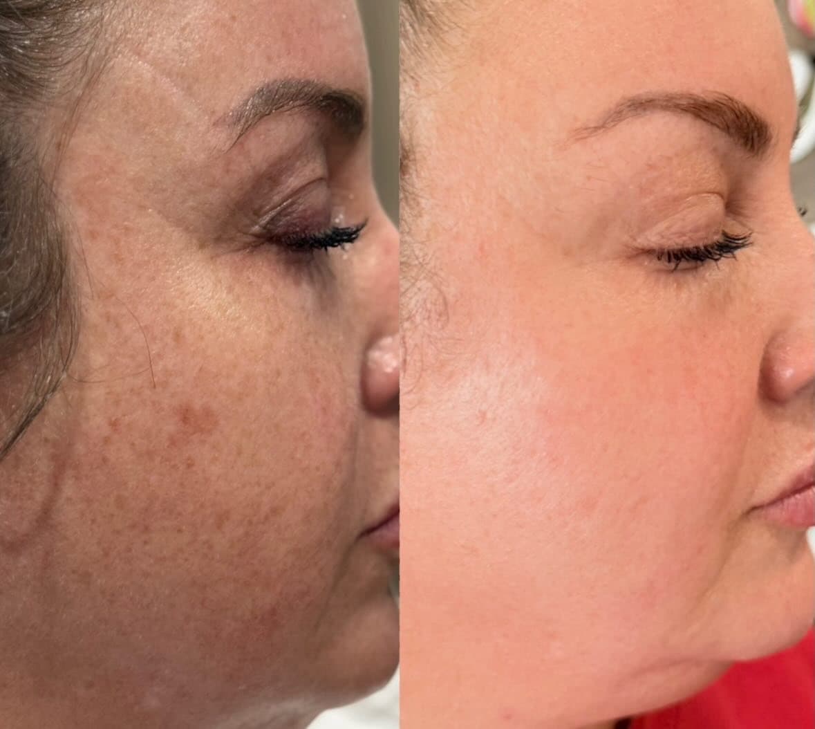 Nouvaderm Laser before and after