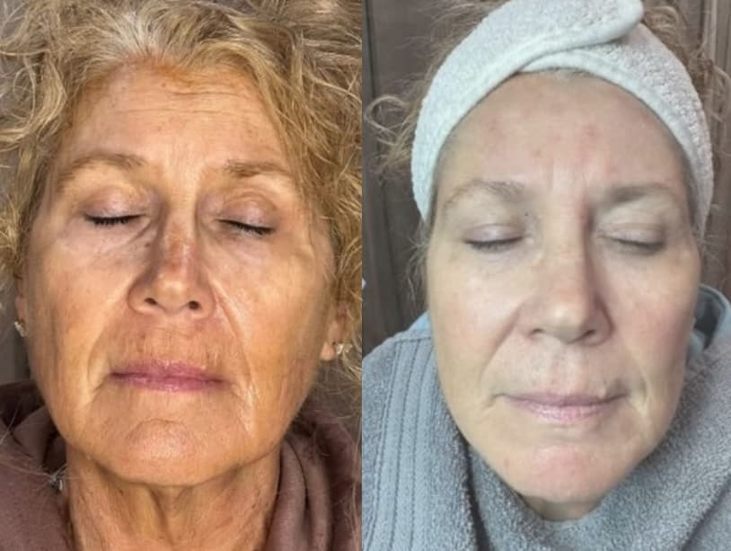 Ultherapy before and after